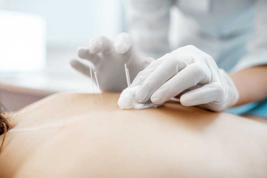 Dry Needling Therapy